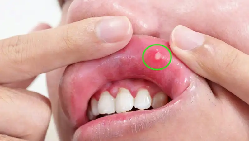 B Vitamini Eksikliği: Belirtilerini Tanıyın, Sağlığınızı Koruyun!
