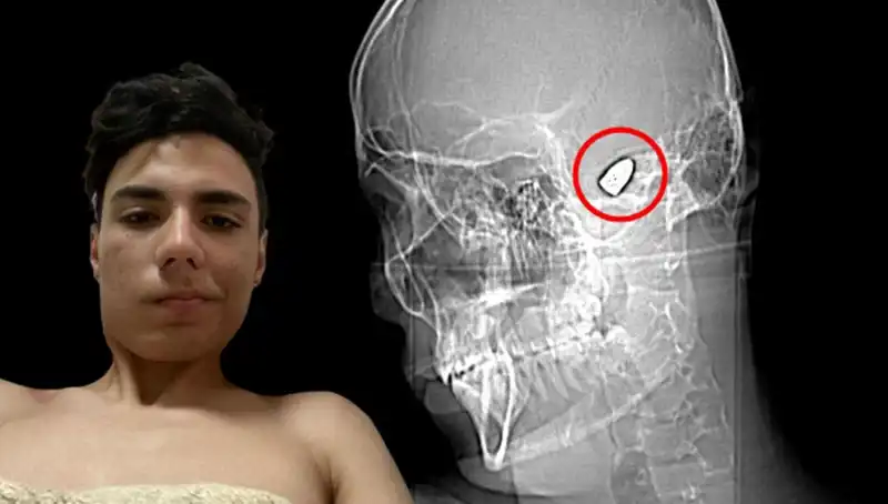 Kafasında Patlamaya Hazır Bomba Taşıyan Genç Adamın Hikayesi