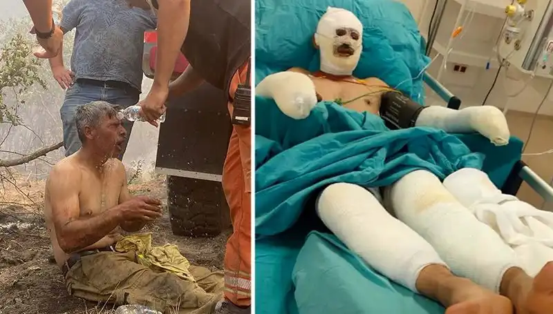 Orman İşçisinin "Yanıyorum" Feryadı, Tedavi Sürecinde Yeni Gelişmeler Yaşanıyor